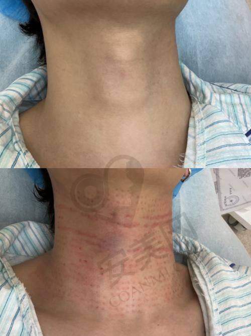 嗨体去颈纹治疗后有哪些注意事项？