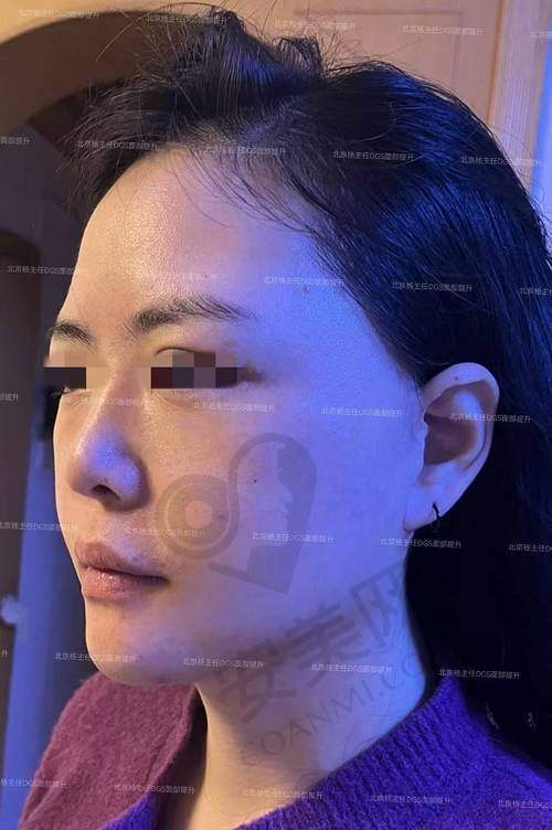 小切口拉皮手术安心吗？需要注意什么？