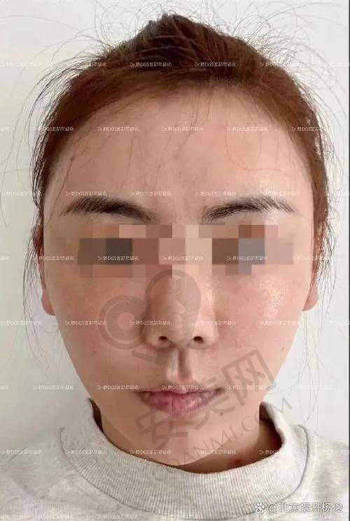 南阳天后整形医院小切口拉皮的独特优势在哪里？