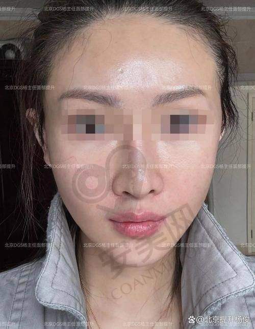 小切口拉皮能解决哪些肌肤问题？