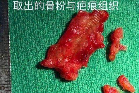 如何选择适合自己的面部注射物取出医院？
