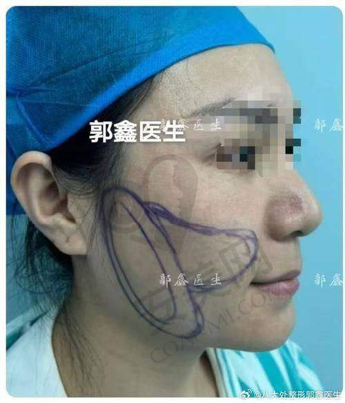 广州荔医有哪些专精技术保护面部注射物取出？