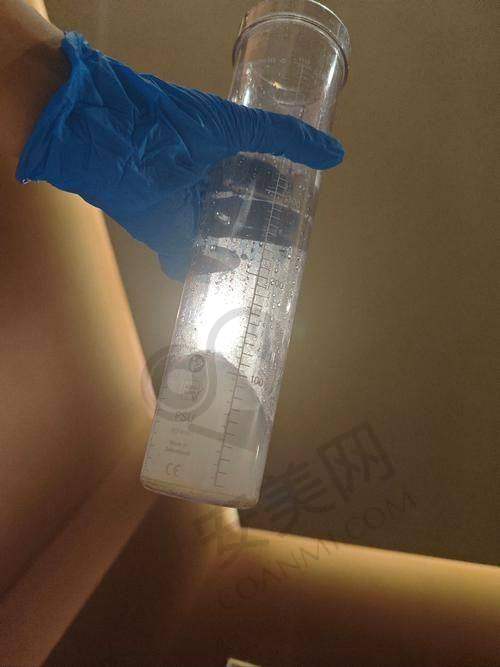 广州荔医面部注射物取出实例成效如何？