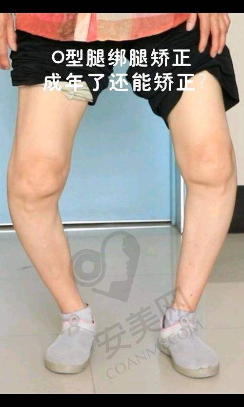 西安西美医院：直腿术的可靠之选