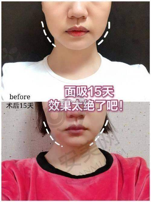 广州军美面部吸脂的成效怎么样？