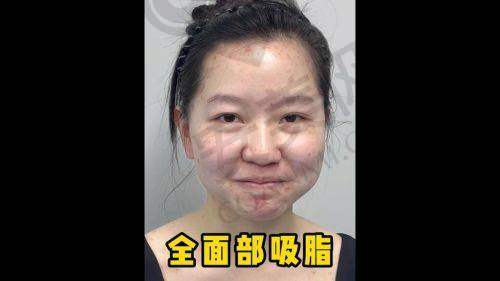 选择广州军美面部吸脂有哪些注意事项？