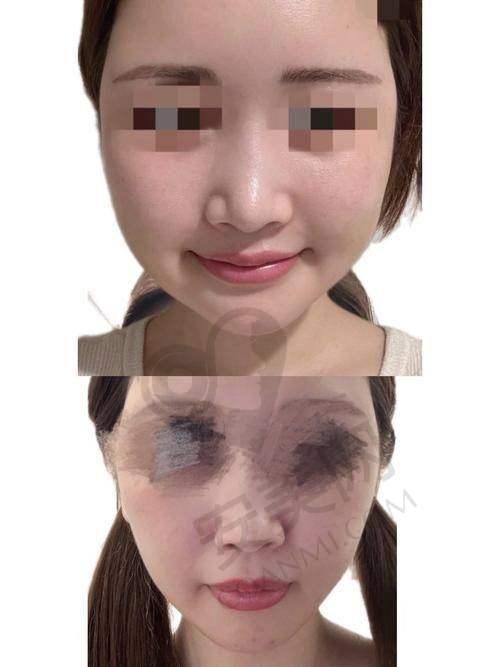 广州军美面部吸脂的修复过程是怎样的？
