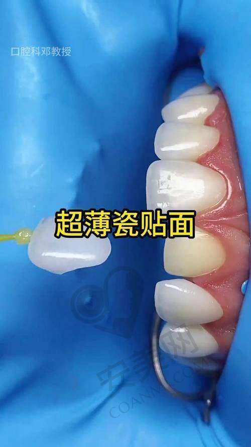 牙齿贴面美白后成效如何？