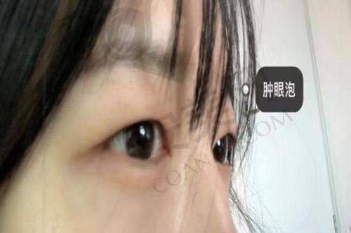 北京丰联丽格全切双眼皮能带来怎样的成效？