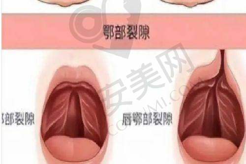 成都现代整形医院唇裂修复技术有何独特之处？