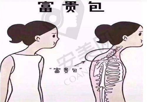 深圳今喜微创去除富贵包的成效显著吗？