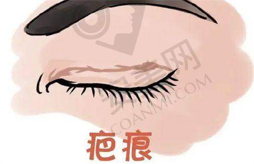 上海艺星双眼皮手术的价格受哪些因素影响？