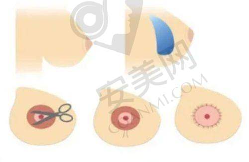如何选择适合自己的双下巴吸脂方案？