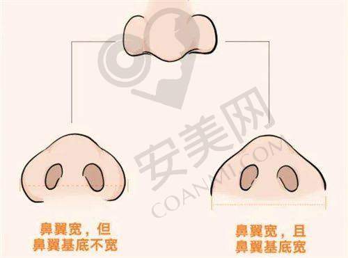 李献和医生腹壁成形术的技术风格是怎样的？