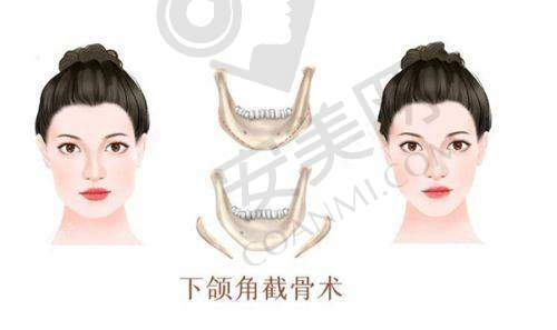 如何选择适合自己的腹壁成形术医生？
