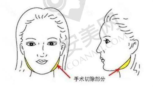 成都中医大银海医院馒化脸修复价格分阶情况