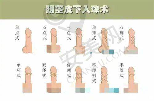 李献和医生的临床经验如何助力腹壁成形术？