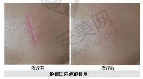 双下巴吸脂术后修复需要注意什么？