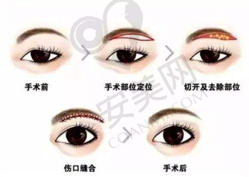 提眉术的手术过程是怎样的？