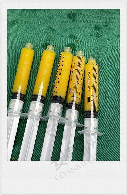 深圳腰腹吸脂医院如何保护手术安心？
