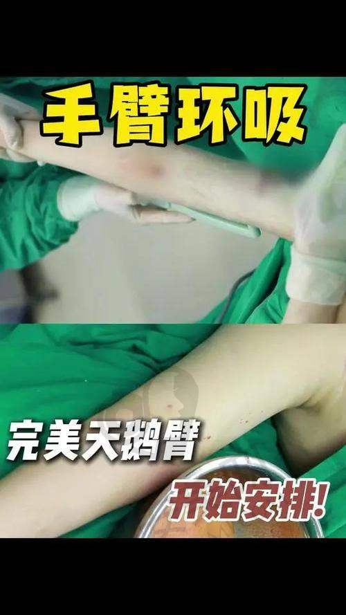手臂吸脂前需要做哪些准备？