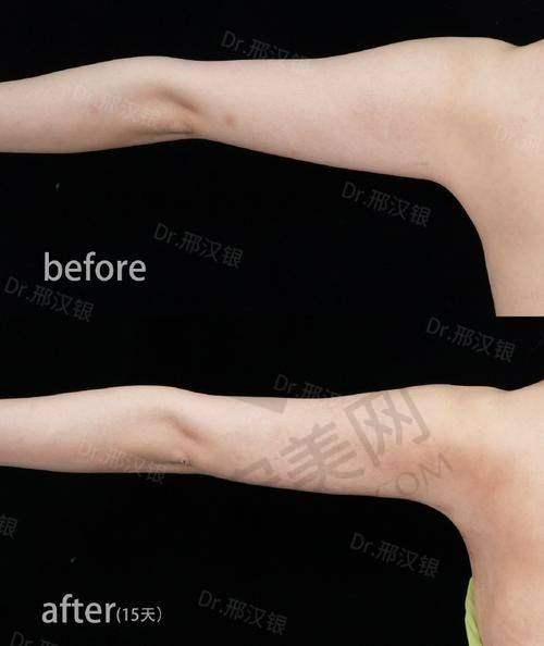 重庆星荣的手臂吸脂技术有什么特色？