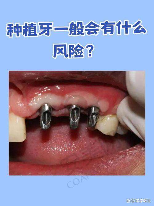 3、西安团圆口腔张保平医生种植牙收费价格：