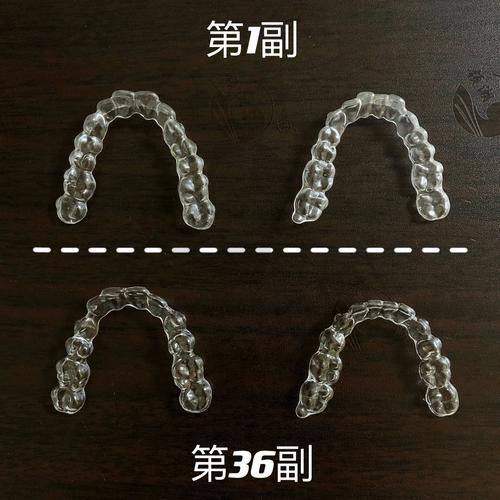 正雅隐形矫正是什么？价格为何13800元起？