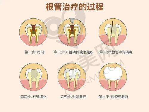 如何预约拉萨雅博仕口腔的根管治疗？