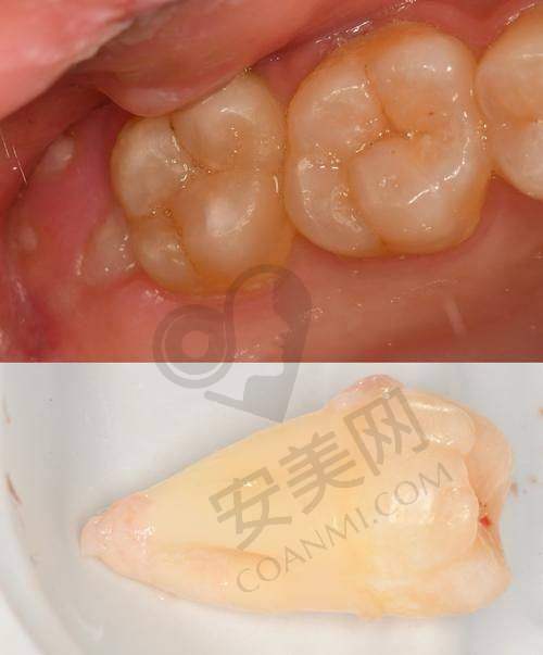 患者在泰安和睦口腔拔除阻生智齿的体验如何？