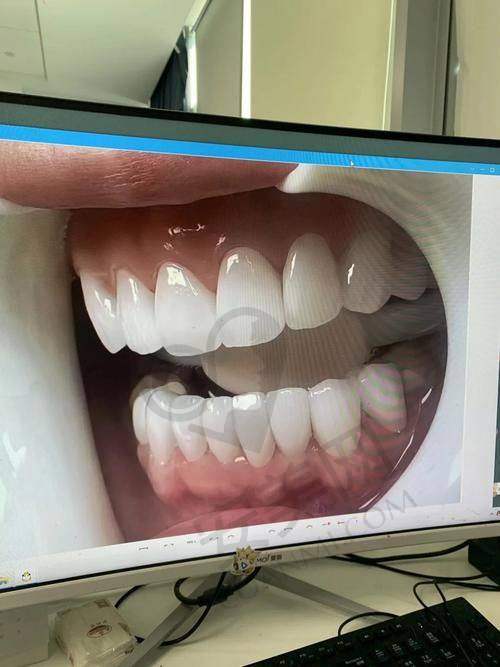 重庆团圆口腔医院牙齿贴面美白的治疗过程是怎样的？