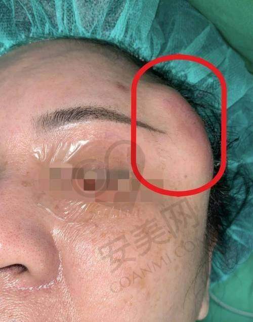 如何选择适合自己的减容馒化修复方案？