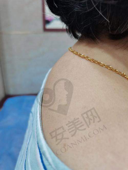 深圳今喜微创去除富贵包和其他方法相比有哪些优势？