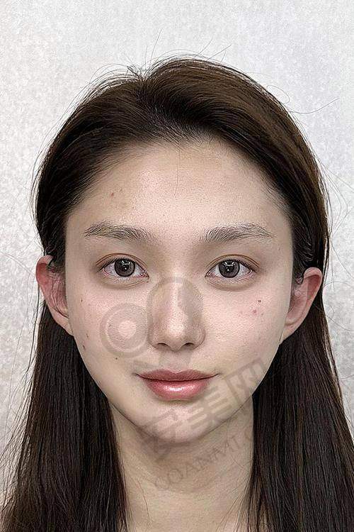上海艺星面部内外轮廓塑形是什么？
