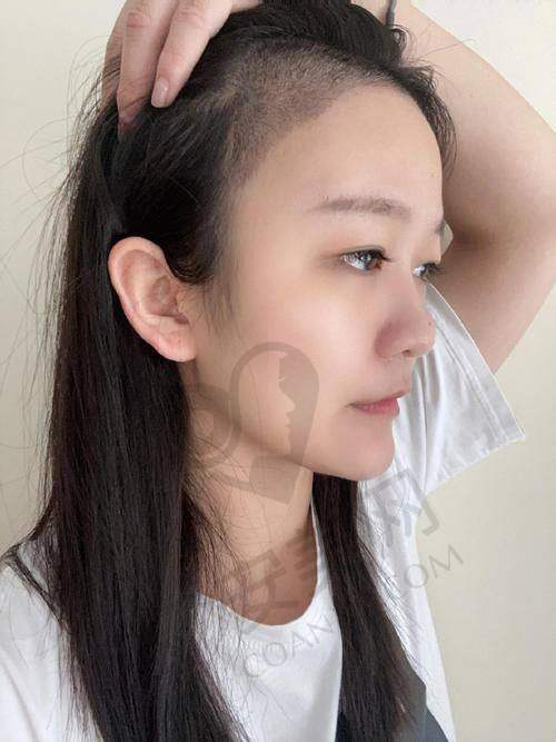 成都大麦微针植发医院剃发加密两千单位的价格与成效成正比吗？