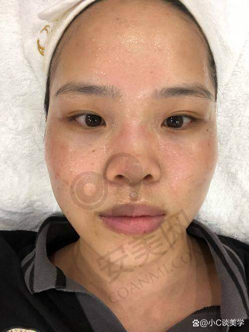 就诊长沙雅美果酸换肤，整体感受如何总结？