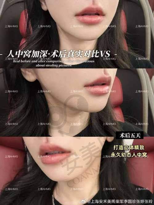 什么是人中窝加深？
