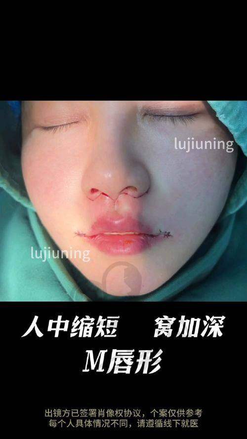 如何选择适合自己的人中窝加深方案？