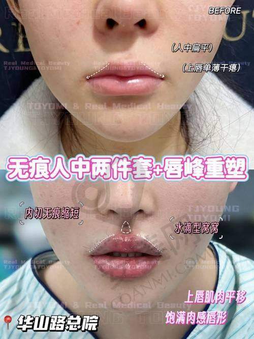 人中窝加深手术的价格受哪些因素影响？