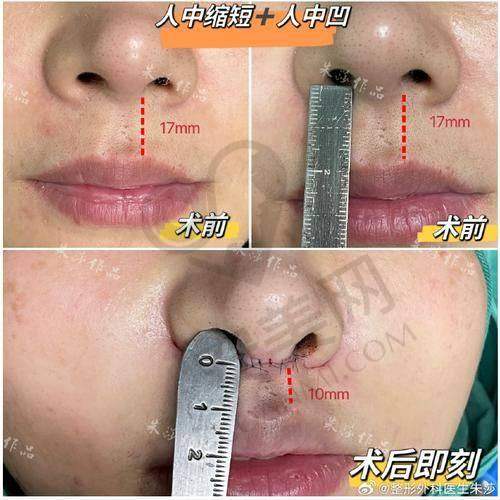 深圳福雅医院开展人中窝加深项目的优势有哪些？