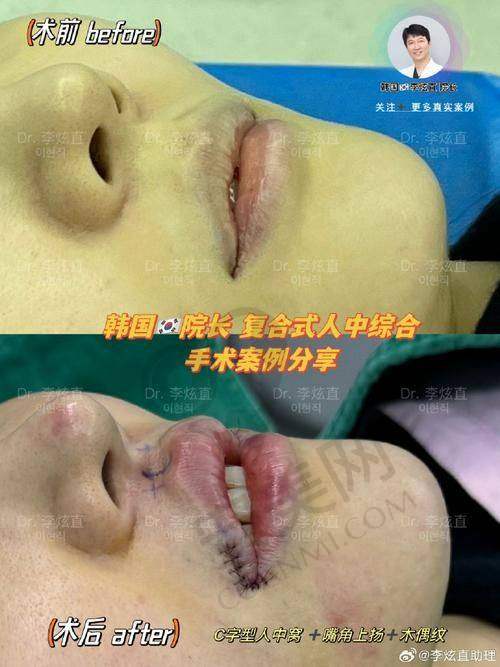 人中窝加深手术的过程是怎样的？