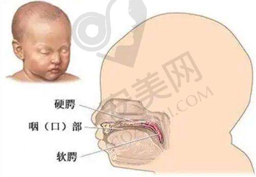 成都现代整形医院修复唇裂技术有什么特色？