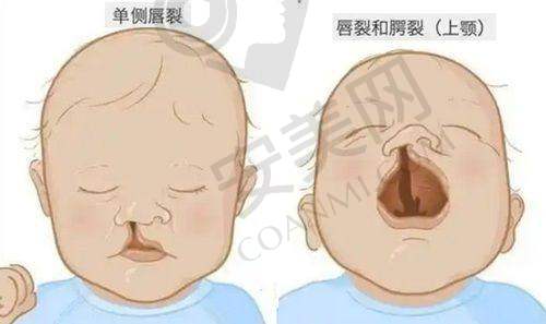 患者在广州高尚医院唇腭裂修复的体验如何？