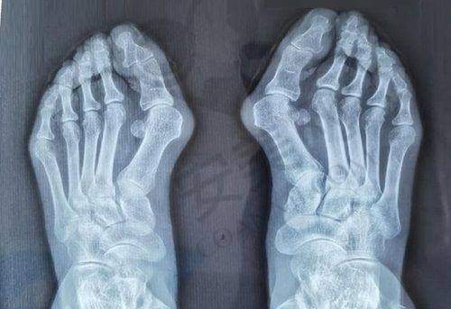 如何选择适合自己的徐州华美双眼皮整形方案？