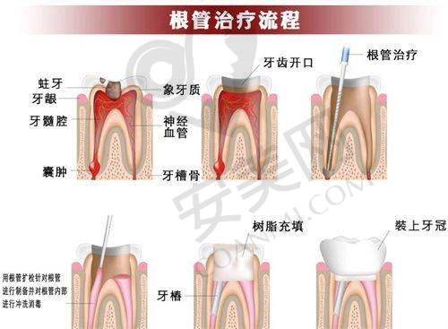 如何选择适合自己的牙齿根管治疗医院？