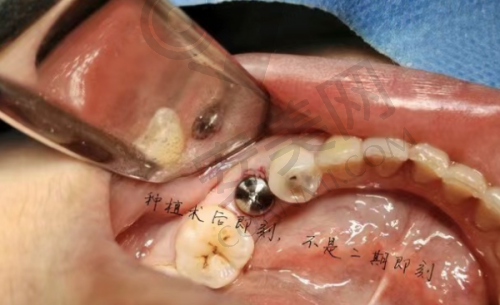 2、禹州微笑口腔刘岱豪医生种植牙怎么样？