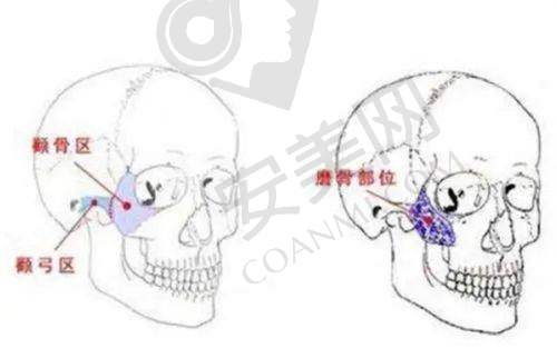 小切口面部拉皮的手术过程是怎样的？