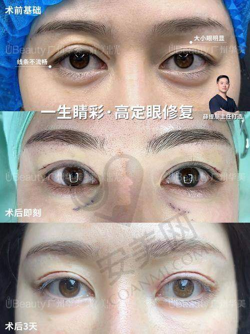 广州美莱肉条感双眼皮修复，医院靠谱吗？