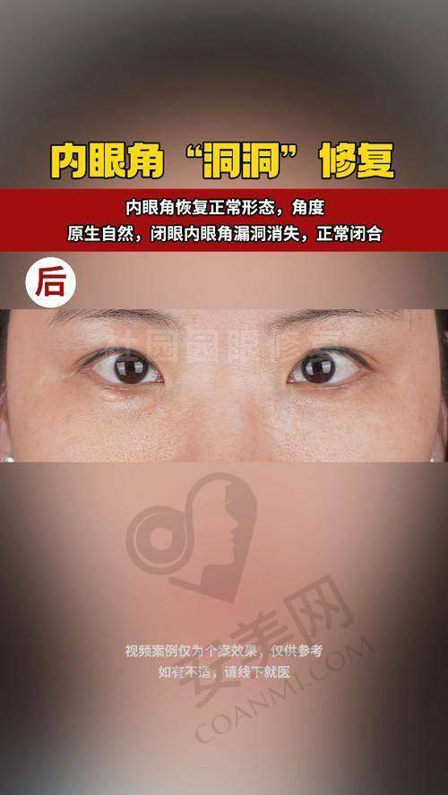沈阳腾采双眼皮修复的诊疗成效让我满意吗？