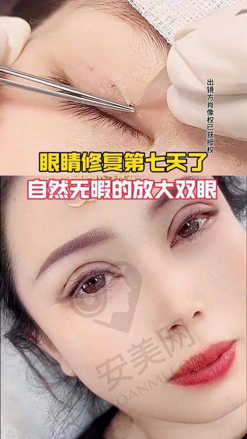 沈阳腾采双眼皮修复技术有什么特色？